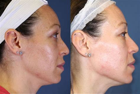 chemical peel st louis|68 Chemical Peel doctors & clinics in Saint Louis, MO .